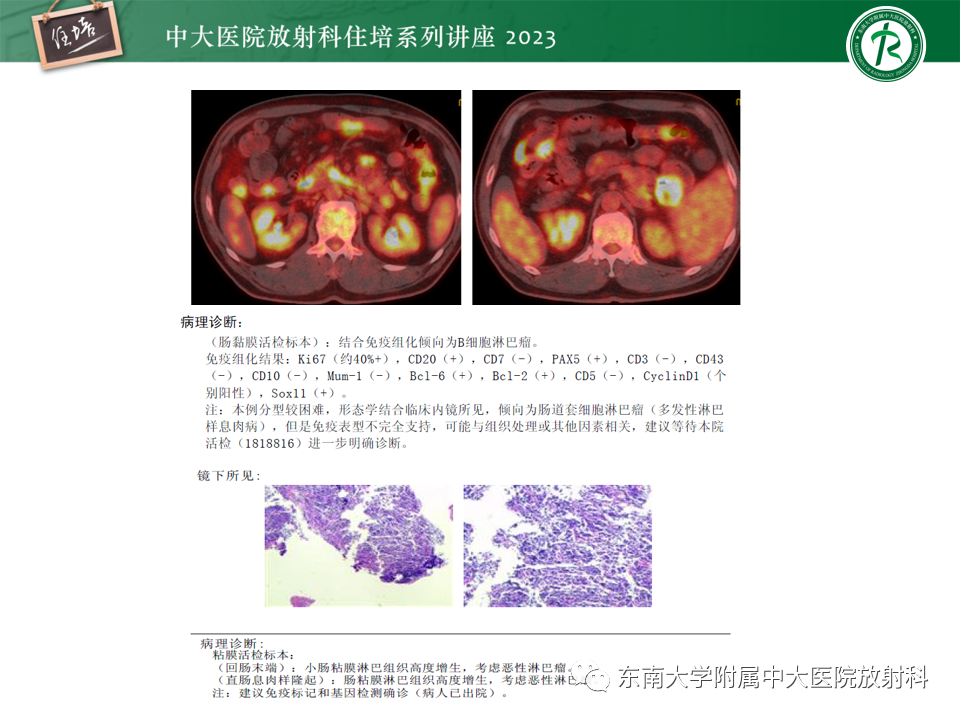 影像PPT - 【PPT】常见十二指肠占位影像诊断-36