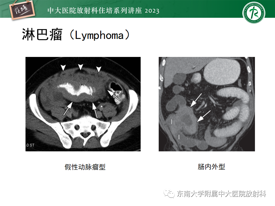 影像PPT - 【PPT】常见十二指肠占位影像诊断-37