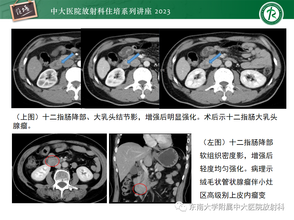 影像PPT - 【PPT】常见十二指肠占位影像诊断-38