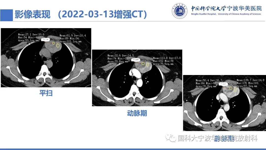 影像PPT - 【PPT】胸内甲状腺肿影像学表现-7