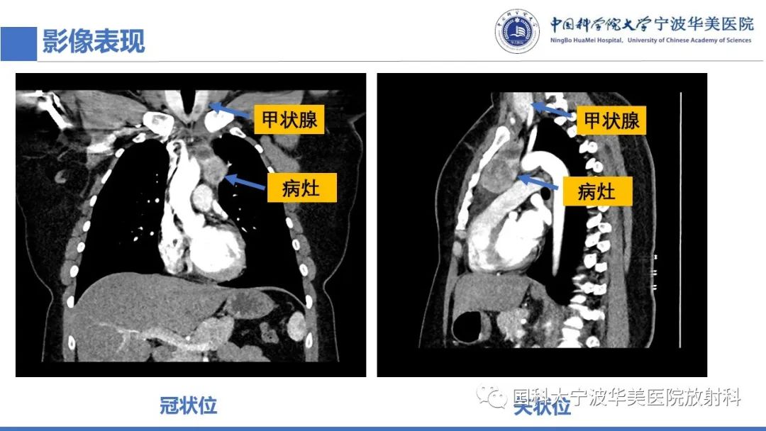 影像PPT - 【PPT】胸内甲状腺肿影像学表现-8