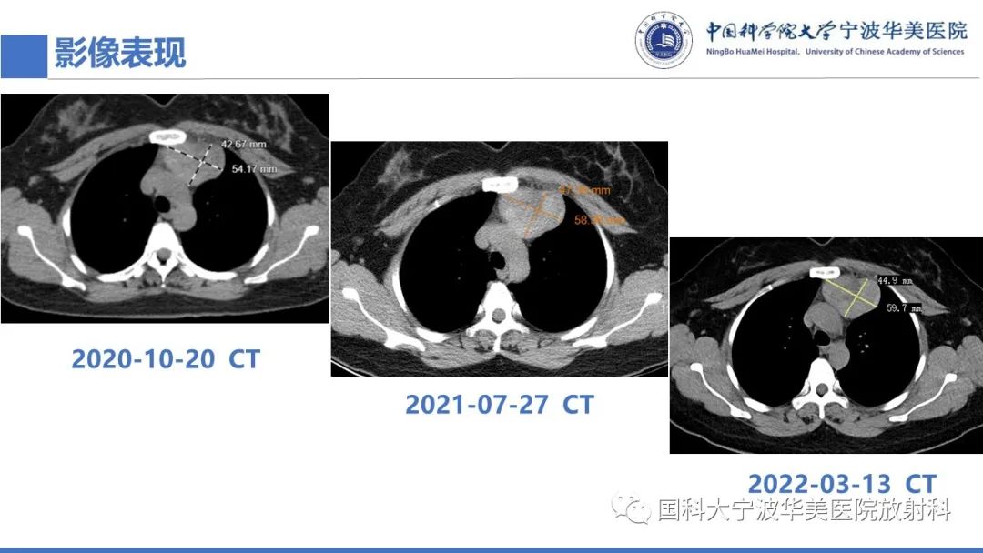 影像PPT - 【PPT】胸内甲状腺肿影像学表现-6