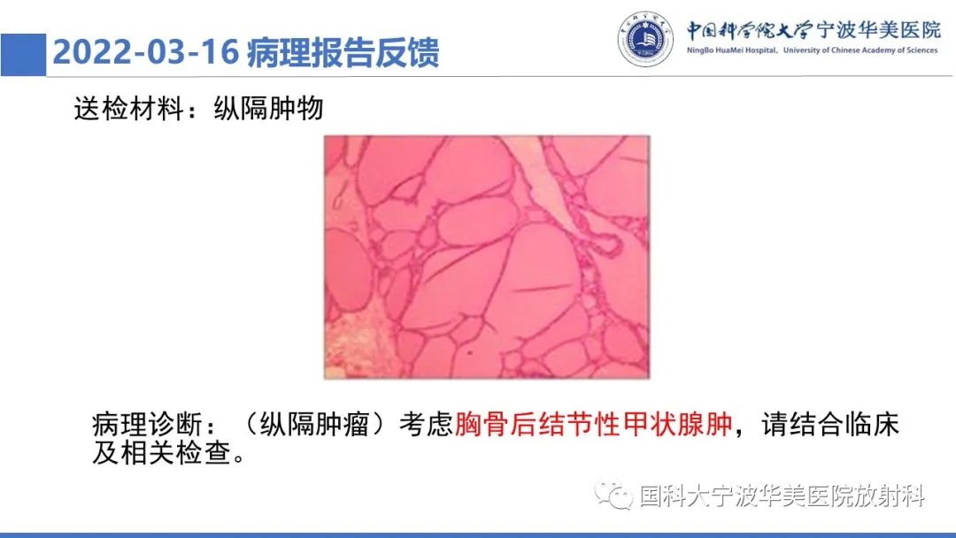 影像PPT - 【PPT】胸内甲状腺肿影像学表现-13