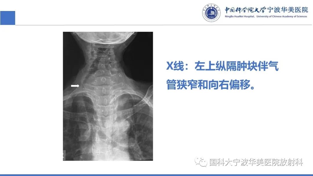 影像PPT - 【PPT】胸内甲状腺肿影像学表现-22
