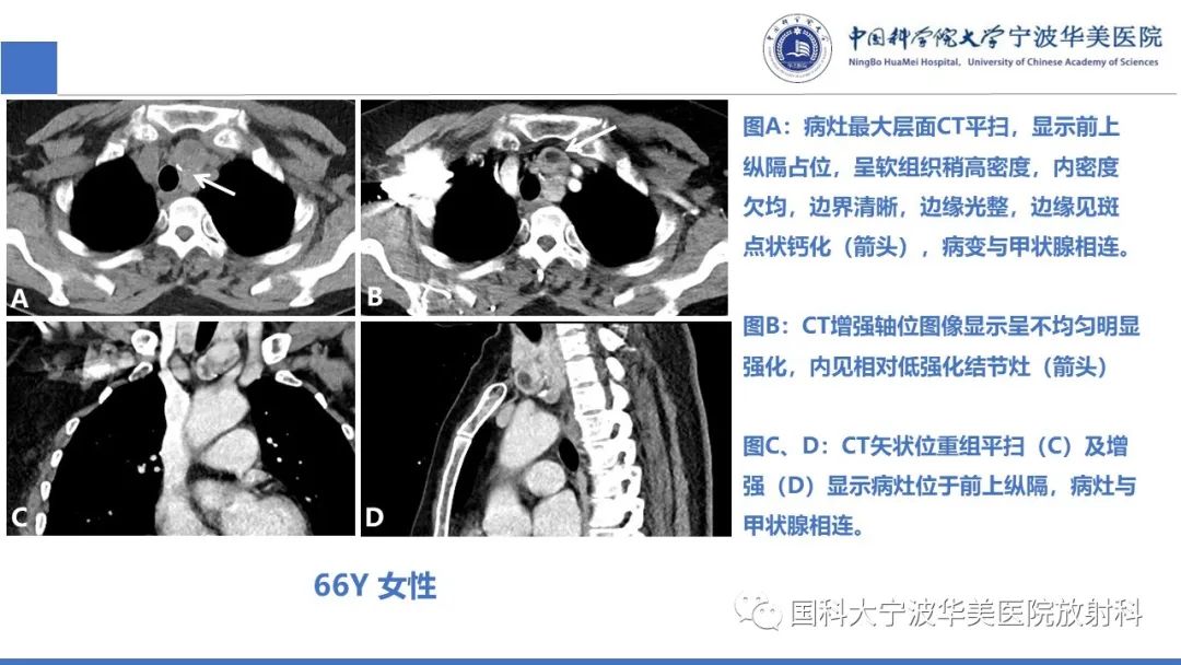 影像PPT - 【PPT】胸内甲状腺肿影像学表现-23
