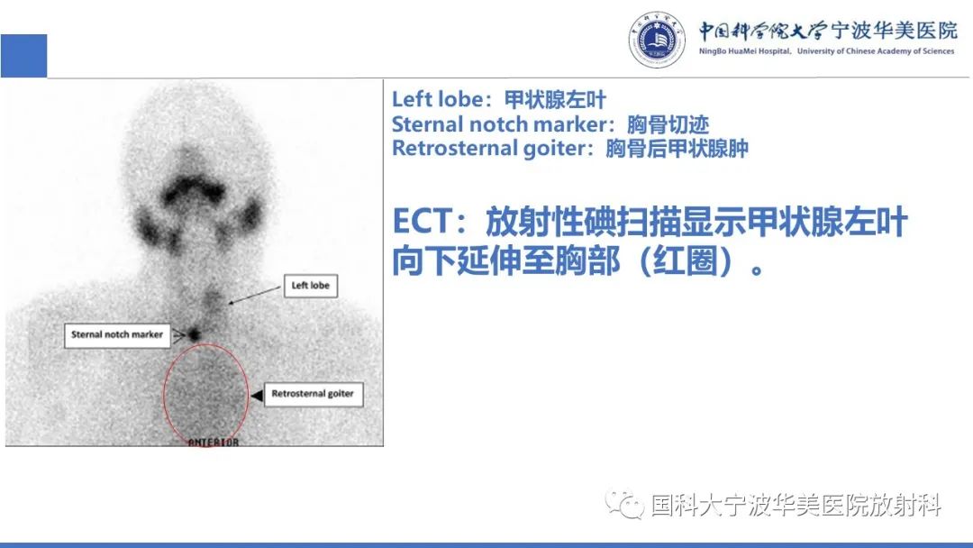 影像PPT - 【PPT】胸内甲状腺肿影像学表现-24