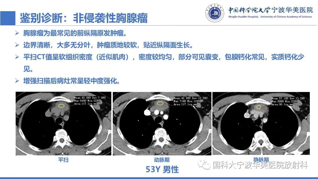 影像PPT - 【PPT】胸内甲状腺肿影像学表现-26