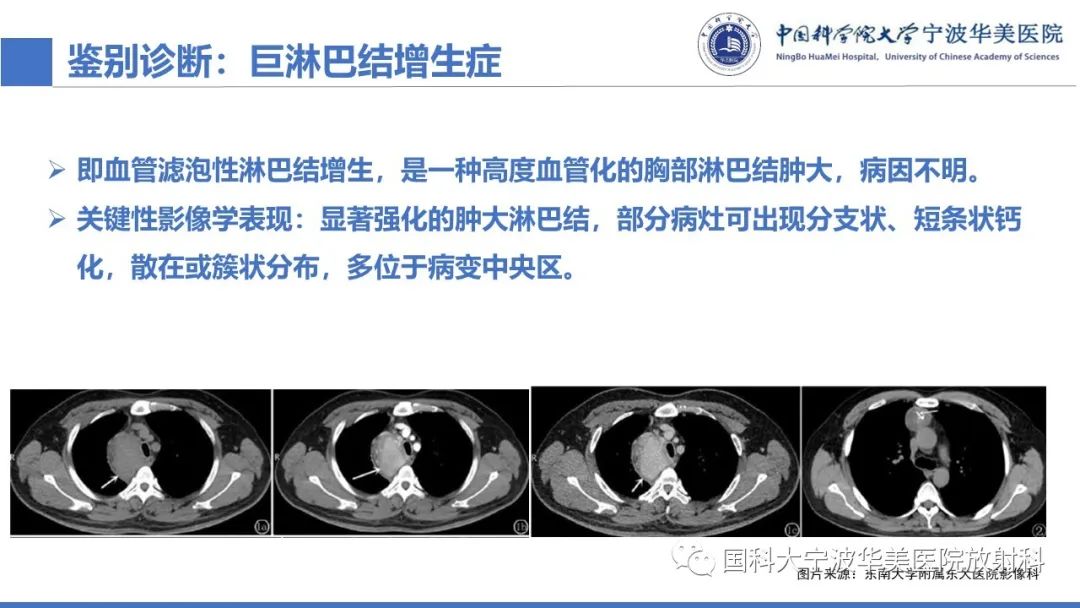影像PPT - 【PPT】胸内甲状腺肿影像学表现-27
