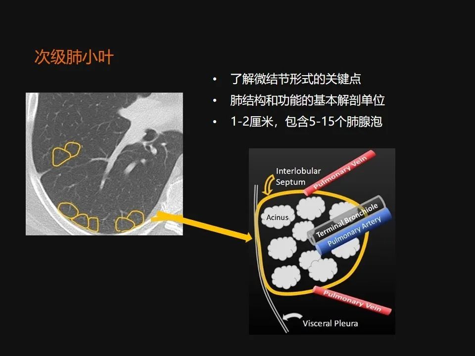 影像PPT - 【PPT】肺微结节的HRCT诊断及鉴别诊断思路-3 影像PPT - 【PPT】肺微结节的HRCT诊断及鉴别诊断思路-3