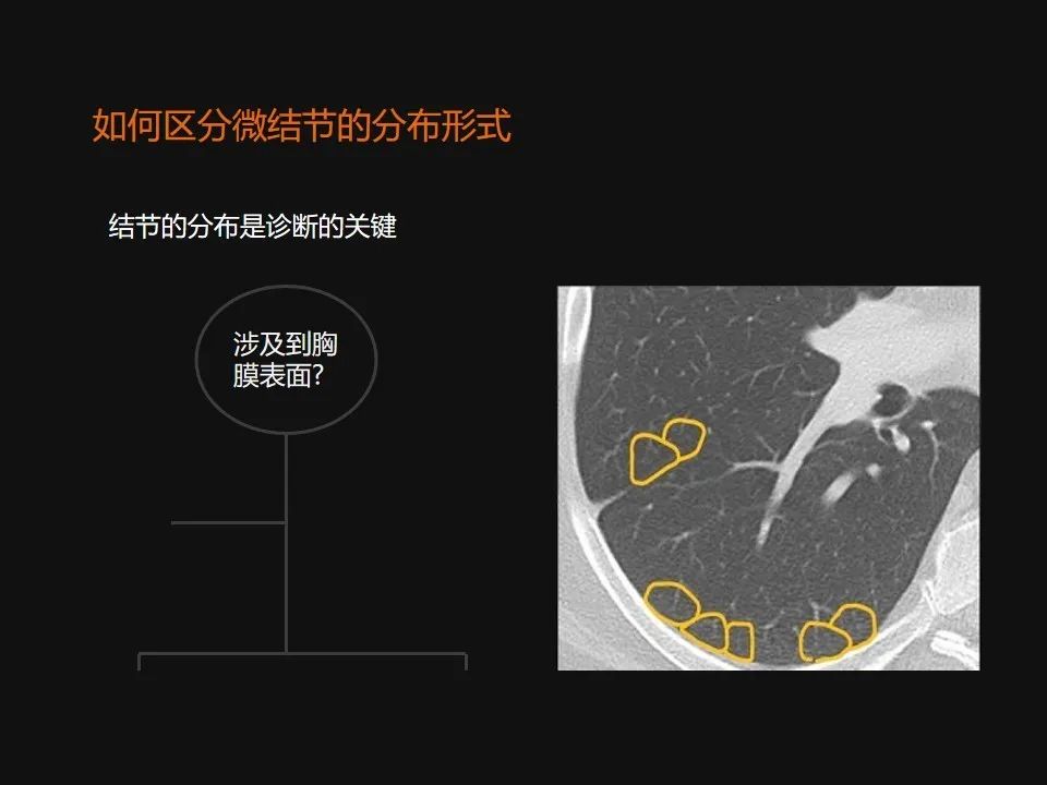 影像PPT - 【PPT】肺微结节的HRCT诊断及鉴别诊断思路-4 影像PPT - 【PPT】肺微结节的HRCT诊断及鉴别诊断思路-4