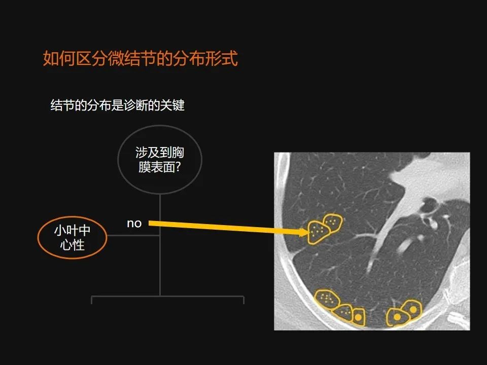 影像PPT - 【PPT】肺微结节的HRCT诊断及鉴别诊断思路-5 影像PPT - 【PPT】肺微结节的HRCT诊断及鉴别诊断思路-5