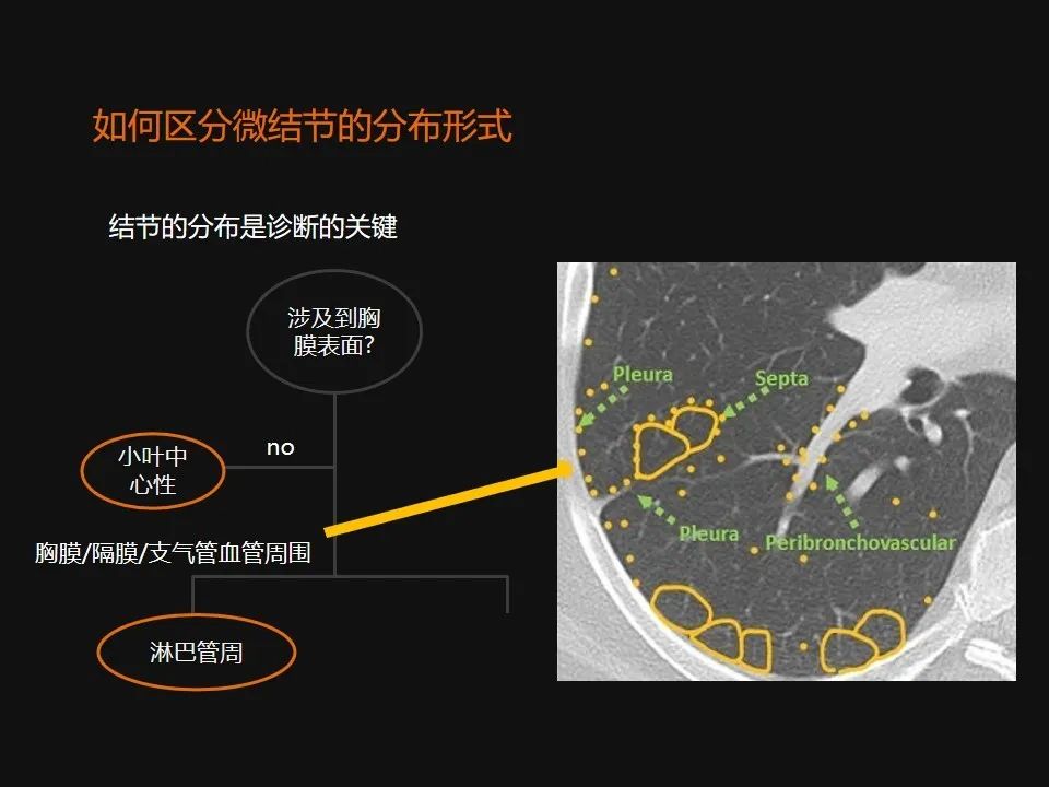 影像PPT - 【PPT】肺微结节的HRCT诊断及鉴别诊断思路-6 影像PPT - 【PPT】肺微结节的HRCT诊断及鉴别诊断思路-6