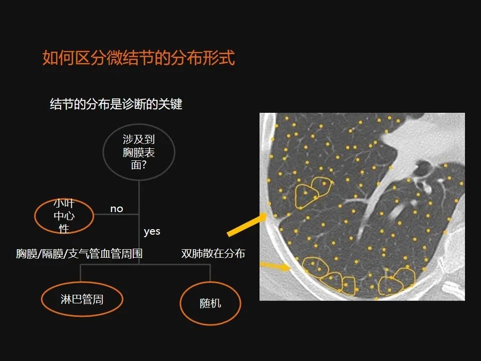 影像PPT - 【PPT】肺微结节的HRCT诊断及鉴别诊断思路-7 影像PPT - 【PPT】肺微结节的HRCT诊断及鉴别诊断思路-7