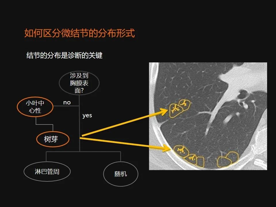 影像PPT - 【PPT】肺微结节的HRCT诊断及鉴别诊断思路-8 影像PPT - 【PPT】肺微结节的HRCT诊断及鉴别诊断思路-8