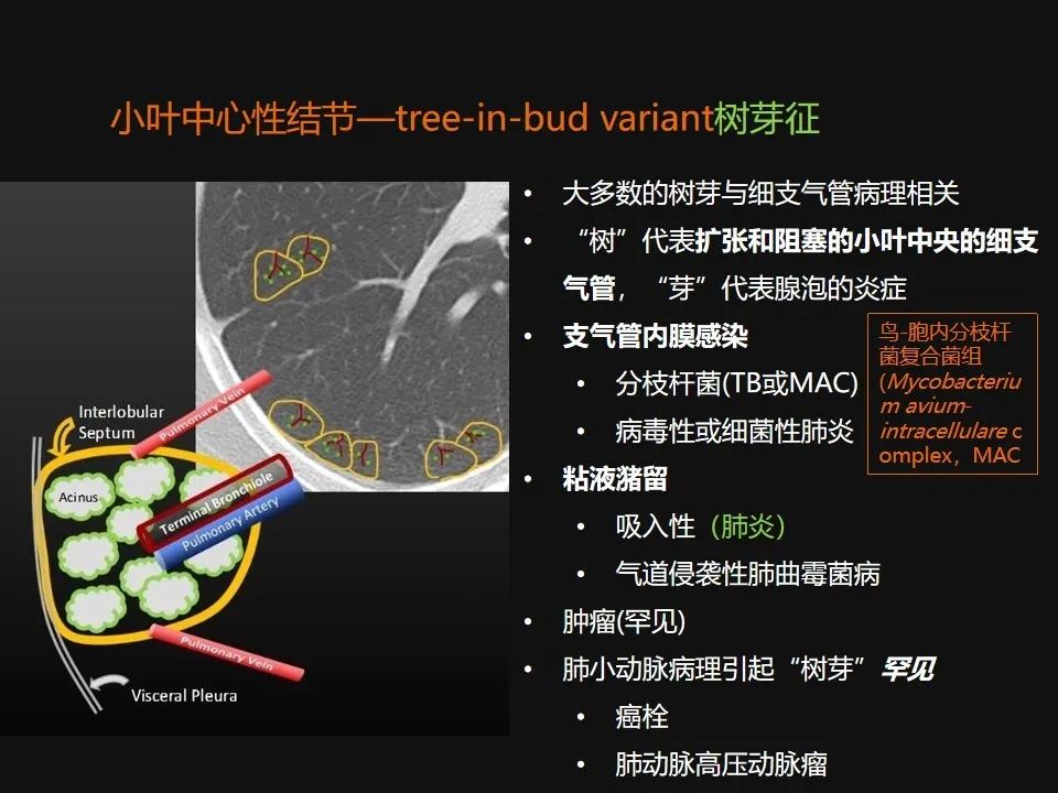 影像PPT - 【PPT】肺微结节的HRCT诊断及鉴别诊断思路-9 影像PPT - 【PPT】肺微结节的HRCT诊断及鉴别诊断思路-9