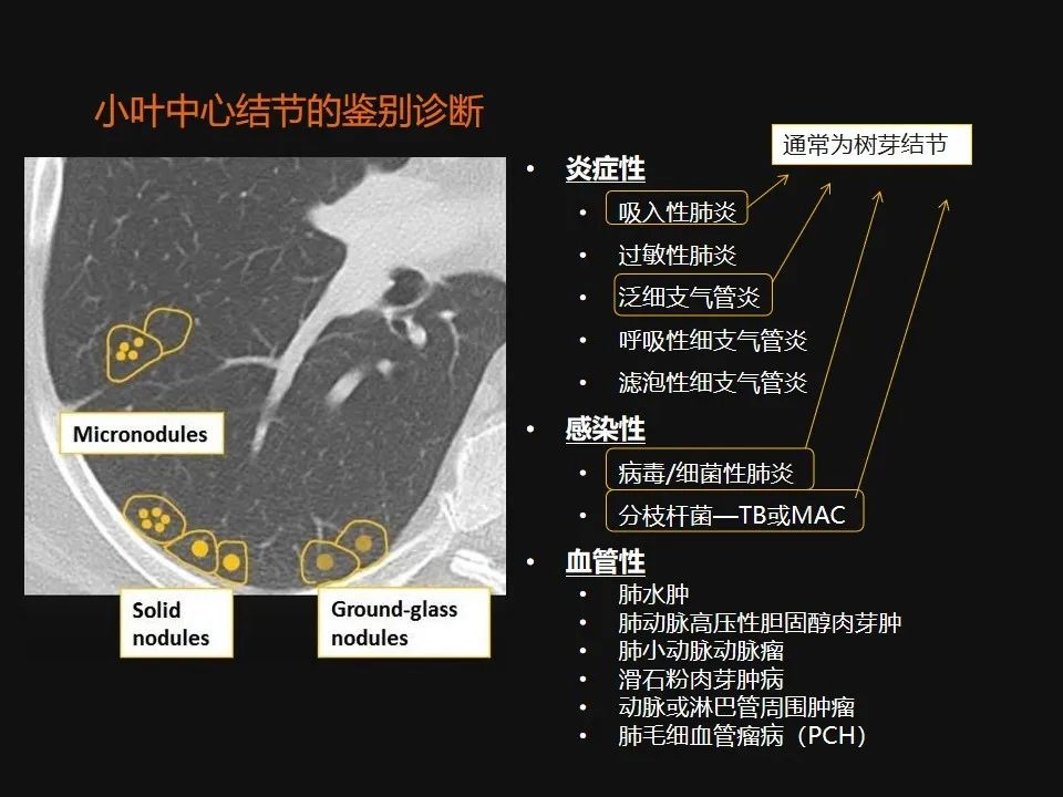 影像PPT - 【PPT】肺微结节的HRCT诊断及鉴别诊断思路-11 影像PPT - 【PPT】肺微结节的HRCT诊断及鉴别诊断思路-11