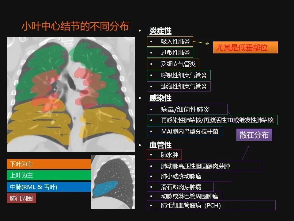 影像PPT - 【PPT】肺微结节的HRCT诊断及鉴别诊断思路-12 影像PPT - 【PPT】肺微结节的HRCT诊断及鉴别诊断思路-12