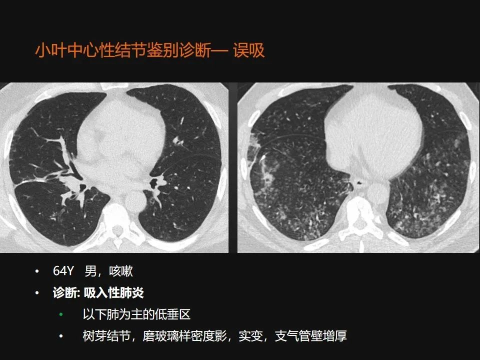 影像PPT - 【PPT】肺微结节的HRCT诊断及鉴别诊断思路-14 影像PPT - 【PPT】肺微结节的HRCT诊断及鉴别诊断思路-14