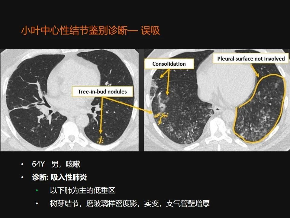 影像PPT - 【PPT】肺微结节的HRCT诊断及鉴别诊断思路-15 影像PPT - 【PPT】肺微结节的HRCT诊断及鉴别诊断思路-15