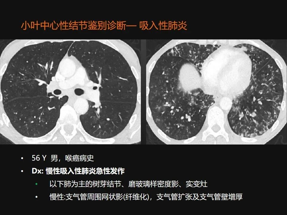 影像PPT - 【PPT】肺微结节的HRCT诊断及鉴别诊断思路-16 影像PPT - 【PPT】肺微结节的HRCT诊断及鉴别诊断思路-16