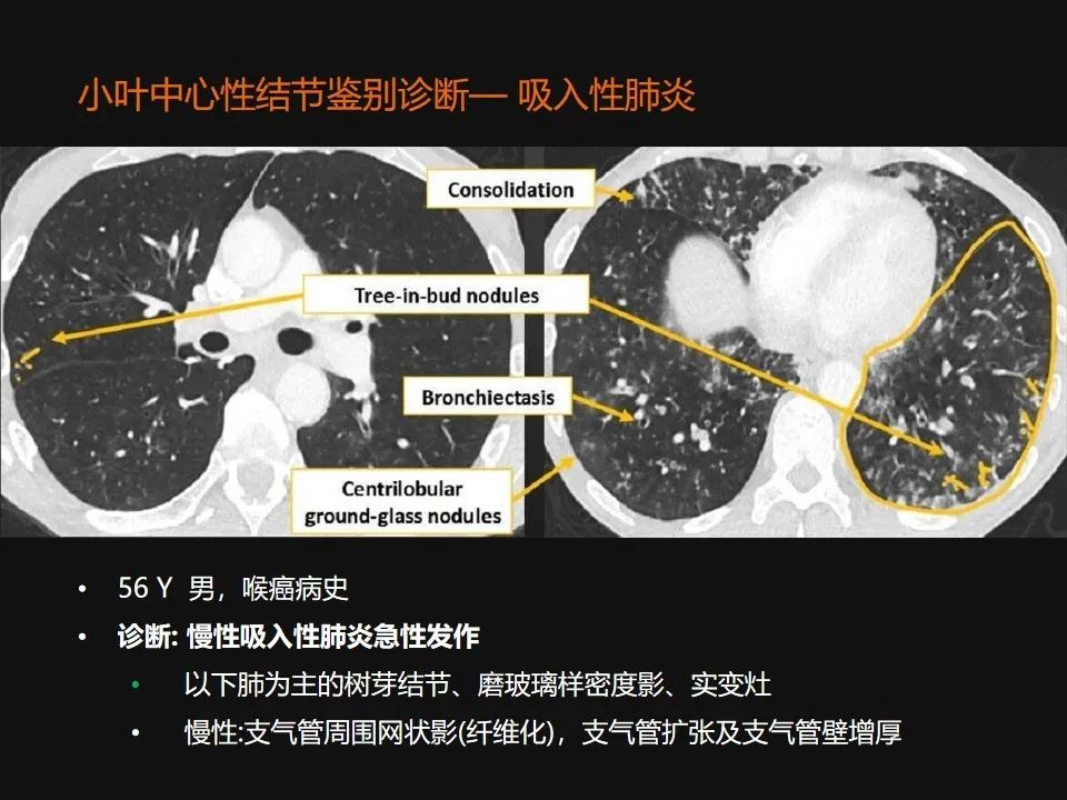 影像PPT - 【PPT】肺微结节的HRCT诊断及鉴别诊断思路-17 影像PPT - 【PPT】肺微结节的HRCT诊断及鉴别诊断思路-17