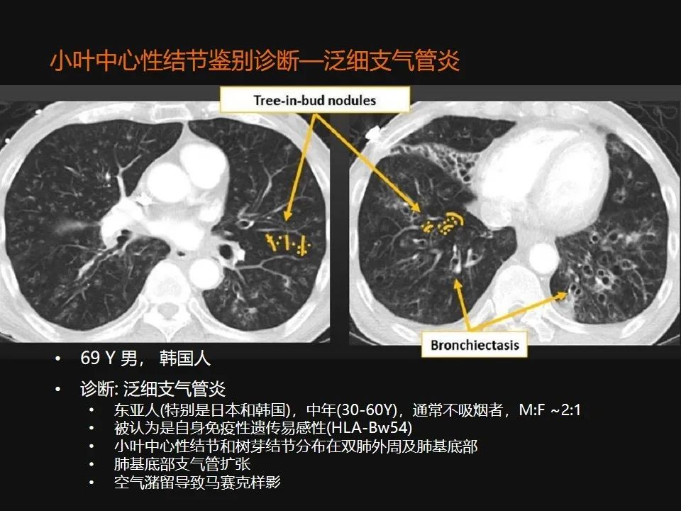 影像PPT - 【PPT】肺微结节的HRCT诊断及鉴别诊断思路-19 影像PPT - 【PPT】肺微结节的HRCT诊断及鉴别诊断思路-19