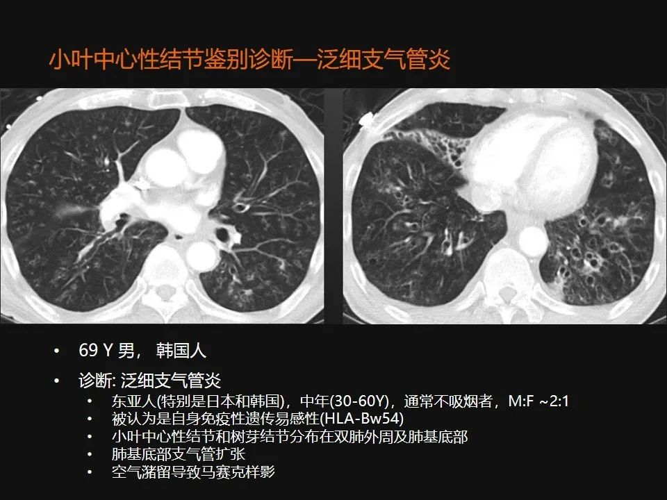 影像PPT - 【PPT】肺微结节的HRCT诊断及鉴别诊断思路-18 影像PPT - 【PPT】肺微结节的HRCT诊断及鉴别诊断思路-18