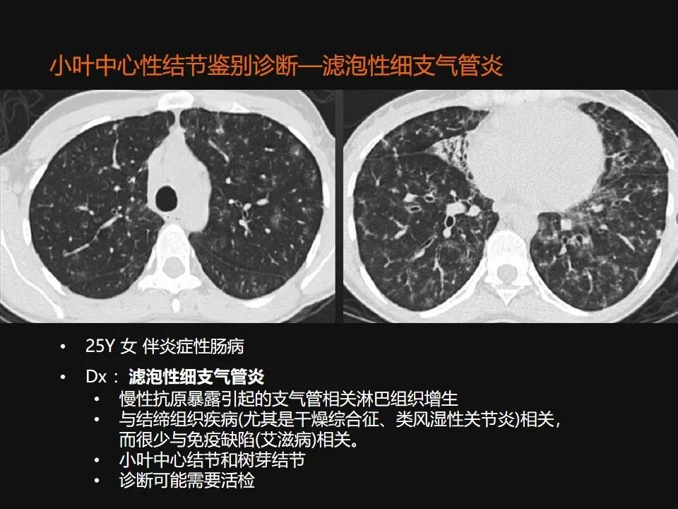 影像PPT - 【PPT】肺微结节的HRCT诊断及鉴别诊断思路-20 影像PPT - 【PPT】肺微结节的HRCT诊断及鉴别诊断思路-20