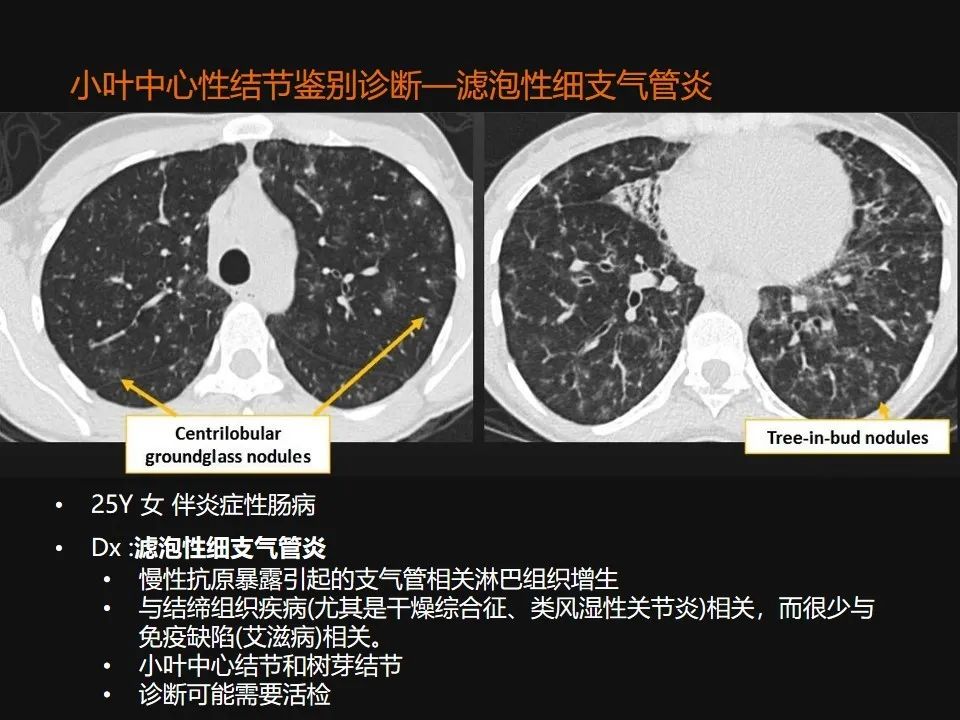 影像PPT - 【PPT】肺微结节的HRCT诊断及鉴别诊断思路-21 影像PPT - 【PPT】肺微结节的HRCT诊断及鉴别诊断思路-21