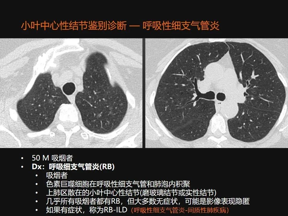 影像PPT - 【PPT】肺微结节的HRCT诊断及鉴别诊断思路-22 影像PPT - 【PPT】肺微结节的HRCT诊断及鉴别诊断思路-22