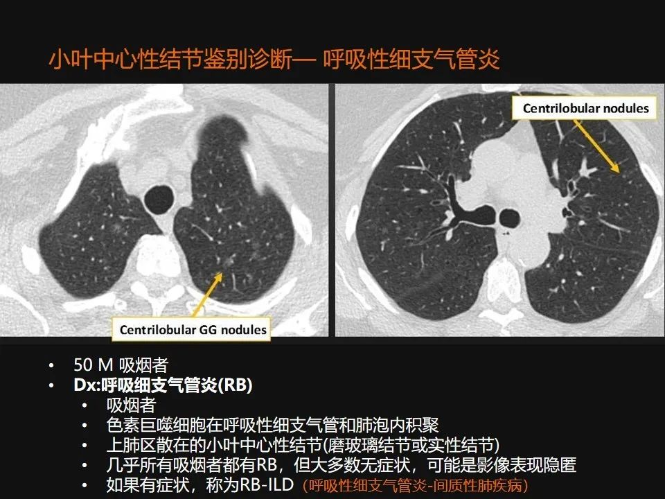 影像PPT - 【PPT】肺微结节的HRCT诊断及鉴别诊断思路-23 影像PPT - 【PPT】肺微结节的HRCT诊断及鉴别诊断思路-23