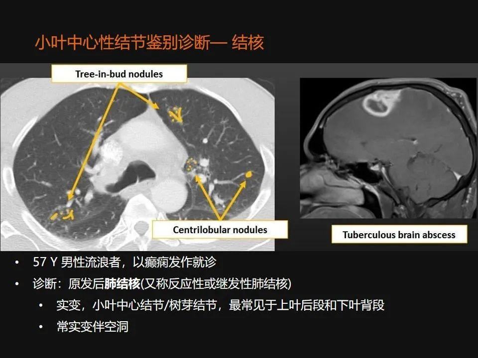影像PPT - 【PPT】肺微结节的HRCT诊断及鉴别诊断思路-25 影像PPT - 【PPT】肺微结节的HRCT诊断及鉴别诊断思路-25