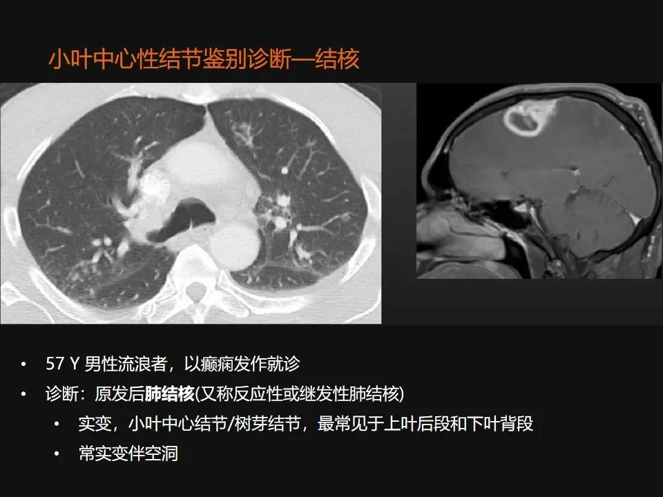 影像PPT - 【PPT】肺微结节的HRCT诊断及鉴别诊断思路-24 影像PPT - 【PPT】肺微结节的HRCT诊断及鉴别诊断思路-24