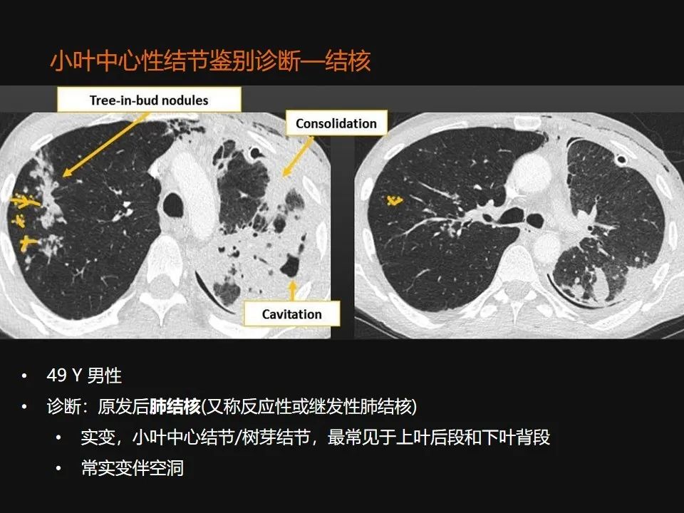 影像PPT - 【PPT】肺微结节的HRCT诊断及鉴别诊断思路-27 影像PPT - 【PPT】肺微结节的HRCT诊断及鉴别诊断思路-27