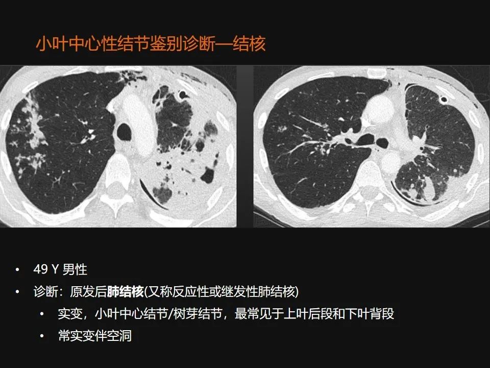 影像PPT - 【PPT】肺微结节的HRCT诊断及鉴别诊断思路-26 影像PPT - 【PPT】肺微结节的HRCT诊断及鉴别诊断思路-26