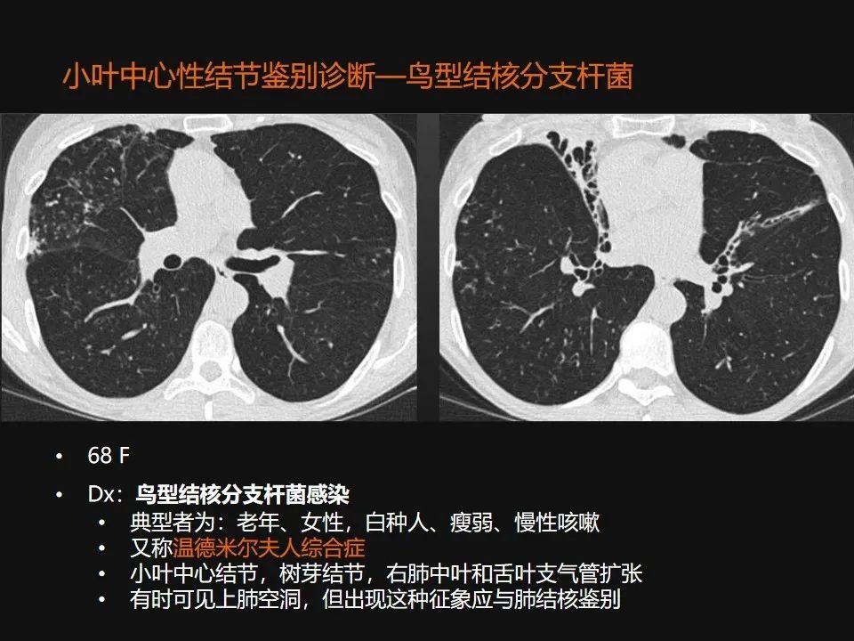 影像PPT - 【PPT】肺微结节的HRCT诊断及鉴别诊断思路-28 影像PPT - 【PPT】肺微结节的HRCT诊断及鉴别诊断思路-28