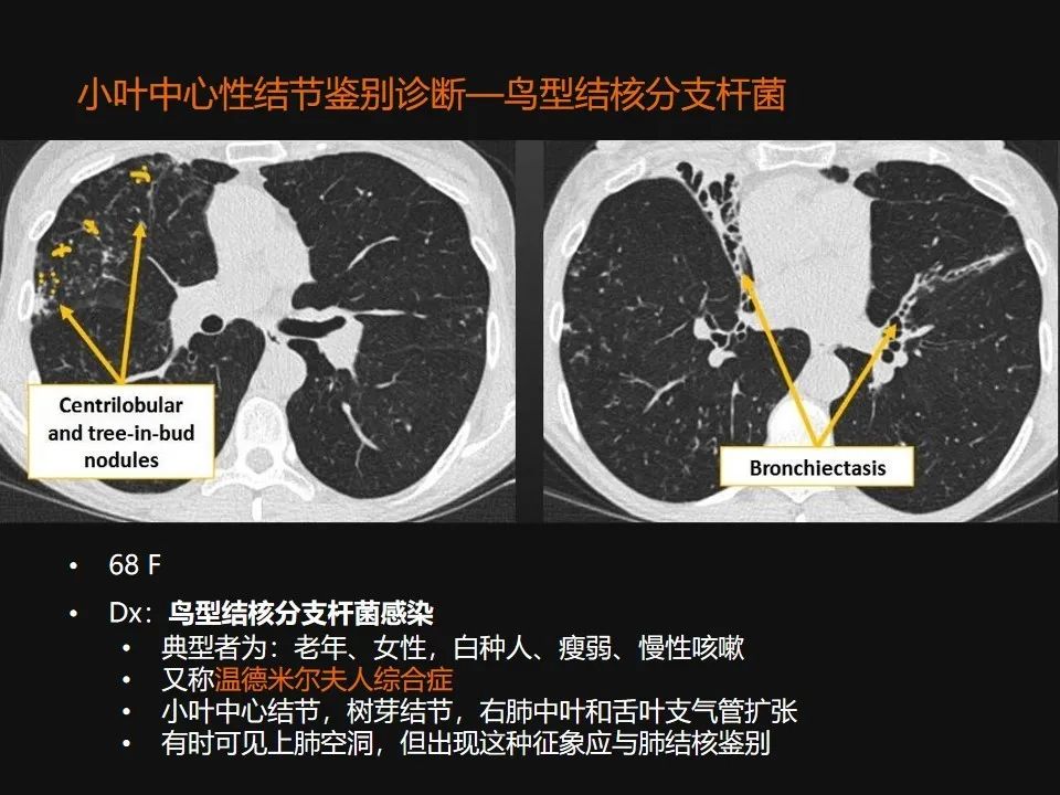 影像PPT - 【PPT】肺微结节的HRCT诊断及鉴别诊断思路-29 影像PPT - 【PPT】肺微结节的HRCT诊断及鉴别诊断思路-29