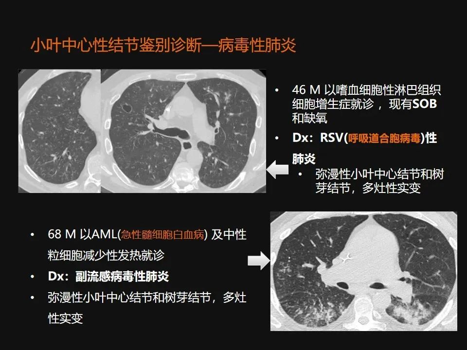 影像PPT - 【PPT】肺微结节的HRCT诊断及鉴别诊断思路-30 影像PPT - 【PPT】肺微结节的HRCT诊断及鉴别诊断思路-30