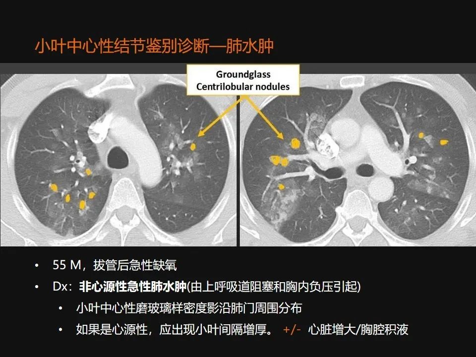 影像PPT - 【PPT】肺微结节的HRCT诊断及鉴别诊断思路-33 影像PPT - 【PPT】肺微结节的HRCT诊断及鉴别诊断思路-33