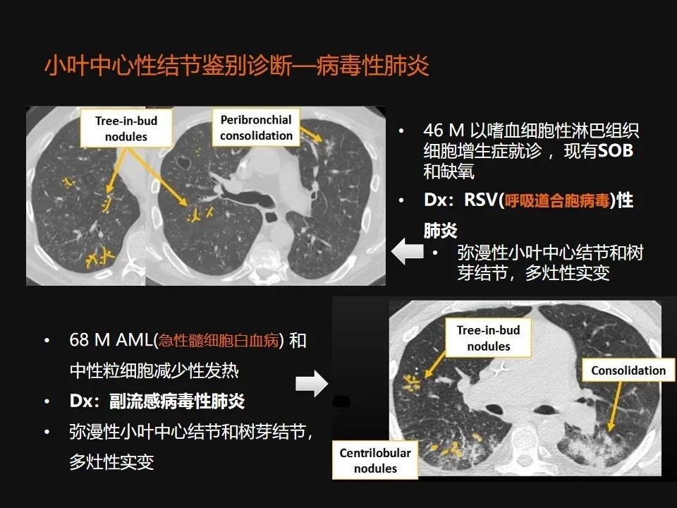 影像PPT - 【PPT】肺微结节的HRCT诊断及鉴别诊断思路-31 影像PPT - 【PPT】肺微结节的HRCT诊断及鉴别诊断思路-31
