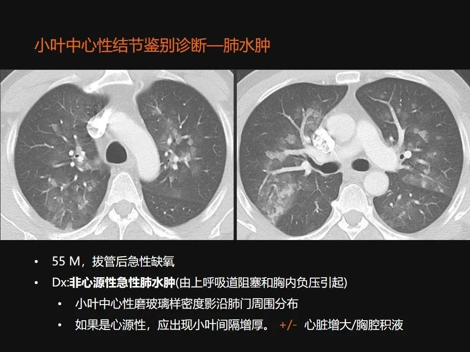 影像PPT - 【PPT】肺微结节的HRCT诊断及鉴别诊断思路-32 影像PPT - 【PPT】肺微结节的HRCT诊断及鉴别诊断思路-32