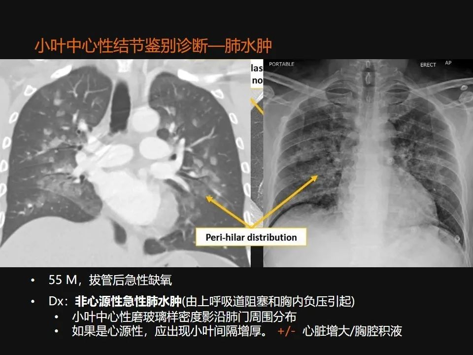 影像PPT - 【PPT】肺微结节的HRCT诊断及鉴别诊断思路-34 影像PPT - 【PPT】肺微结节的HRCT诊断及鉴别诊断思路-34