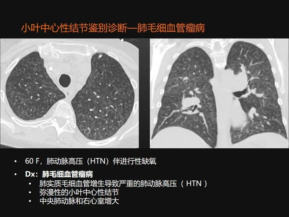 影像PPT - 【PPT】肺微结节的HRCT诊断及鉴别诊断思路-35 影像PPT - 【PPT】肺微结节的HRCT诊断及鉴别诊断思路-35