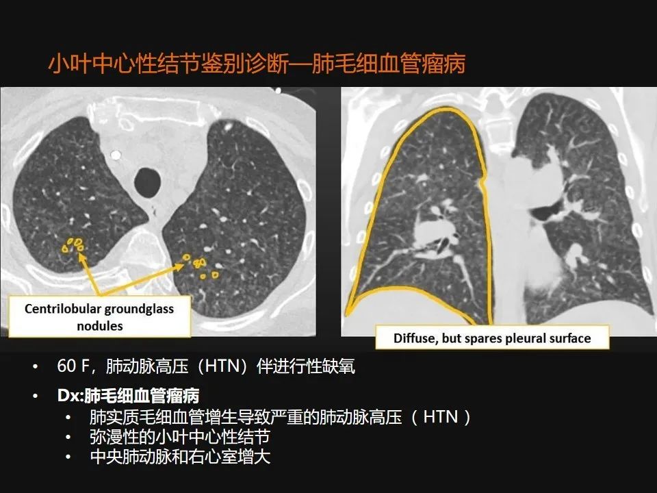 影像PPT - 【PPT】肺微结节的HRCT诊断及鉴别诊断思路-36 影像PPT - 【PPT】肺微结节的HRCT诊断及鉴别诊断思路-36