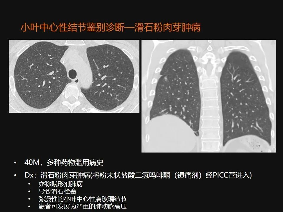 影像PPT - 【PPT】肺微结节的HRCT诊断及鉴别诊断思路-37 影像PPT - 【PPT】肺微结节的HRCT诊断及鉴别诊断思路-37