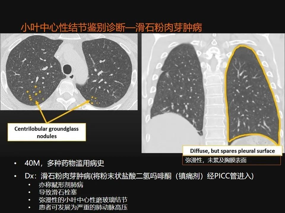 影像PPT - 【PPT】肺微结节的HRCT诊断及鉴别诊断思路-38 影像PPT - 【PPT】肺微结节的HRCT诊断及鉴别诊断思路-38