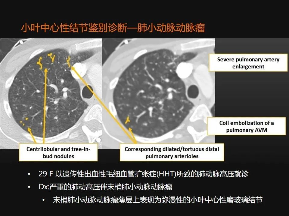 影像PPT - 【PPT】肺微结节的HRCT诊断及鉴别诊断思路-40 影像PPT - 【PPT】肺微结节的HRCT诊断及鉴别诊断思路-40