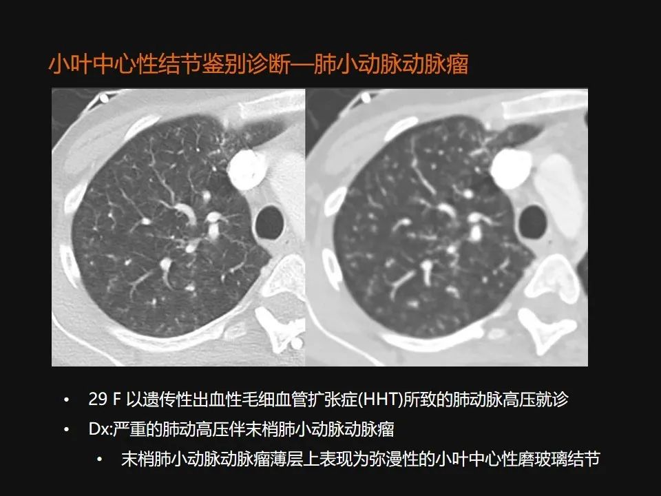影像PPT - 【PPT】肺微结节的HRCT诊断及鉴别诊断思路-39 影像PPT - 【PPT】肺微结节的HRCT诊断及鉴别诊断思路-39