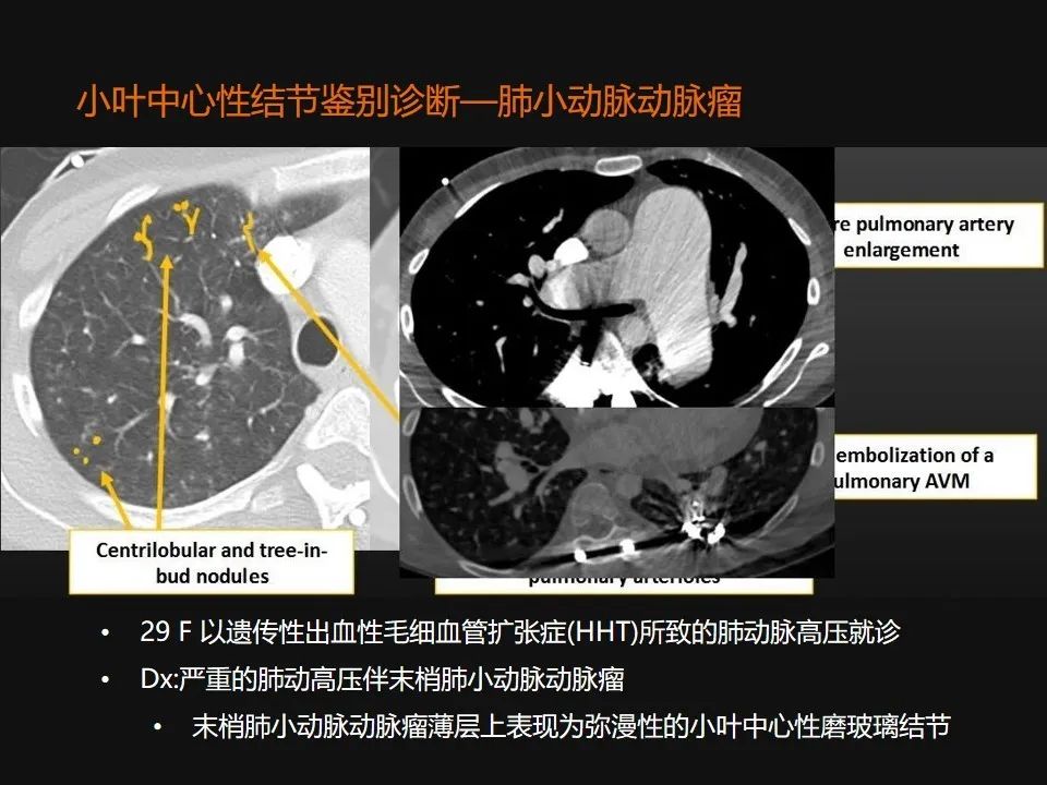影像PPT - 【PPT】肺微结节的HRCT诊断及鉴别诊断思路-41 影像PPT - 【PPT】肺微结节的HRCT诊断及鉴别诊断思路-41