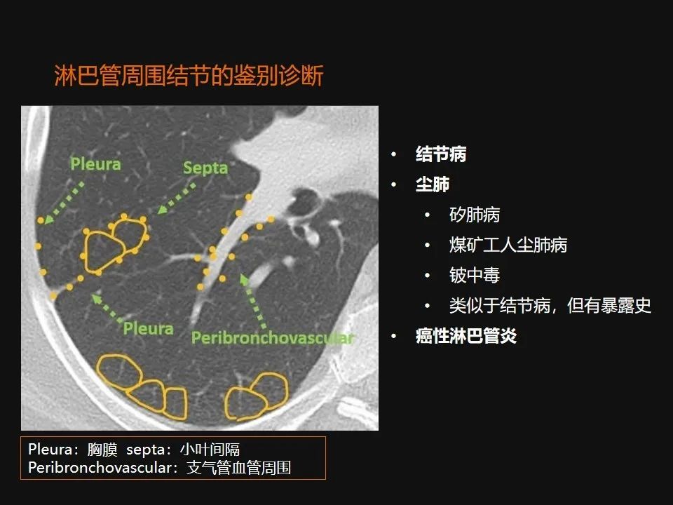 影像PPT - 【PPT】肺微结节的HRCT诊断及鉴别诊断思路-42 影像PPT - 【PPT】肺微结节的HRCT诊断及鉴别诊断思路-42